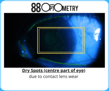 Read more about the article Extreme Dry Eye Due to Contact Lens Wear