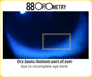 Read more about the article Dry Spots & Dry Eye