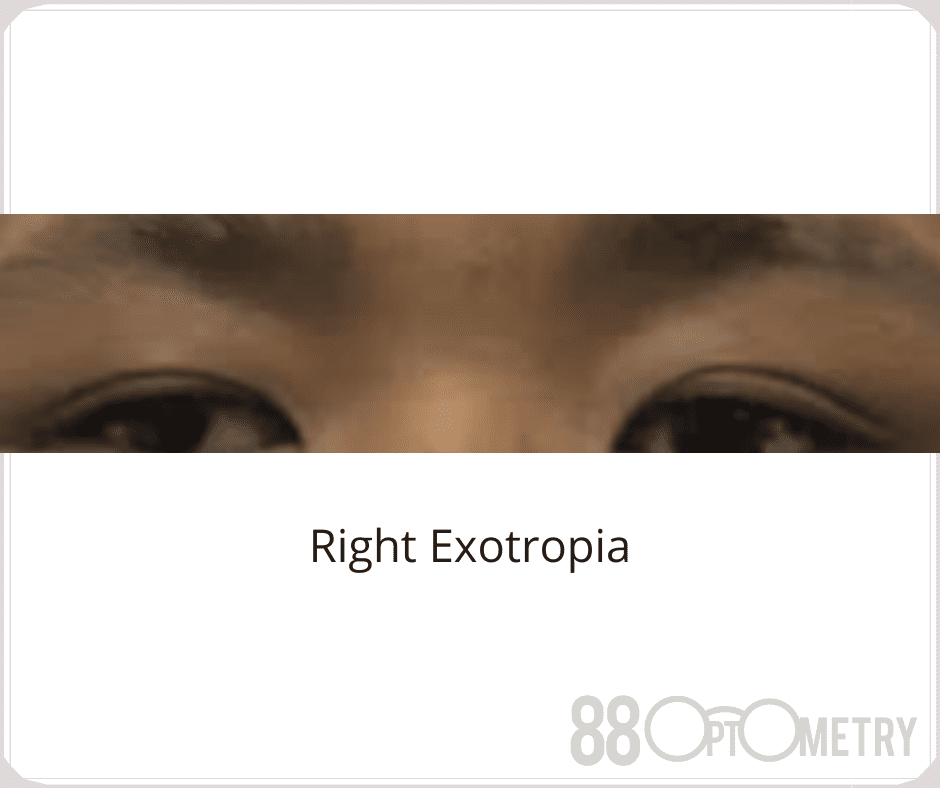 You are currently viewing Strabismus & Amblyopia?