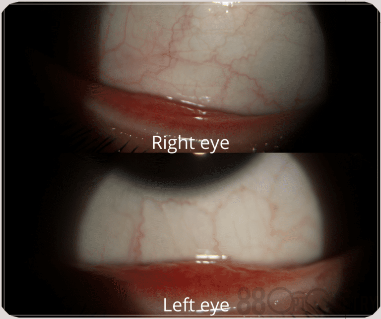 Read more about the article Big Bumps Underneath Eyelid?